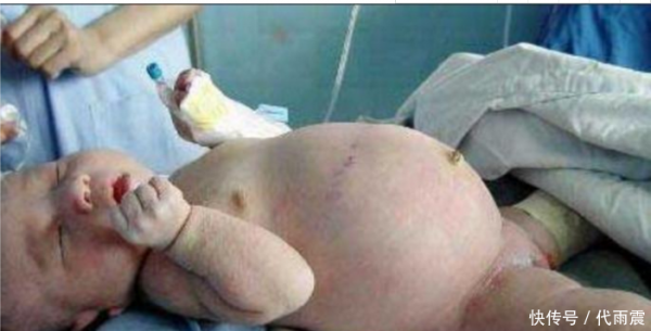 半岁女儿肚子大如球, 医生检查过后动手术剖腹取出了个男婴